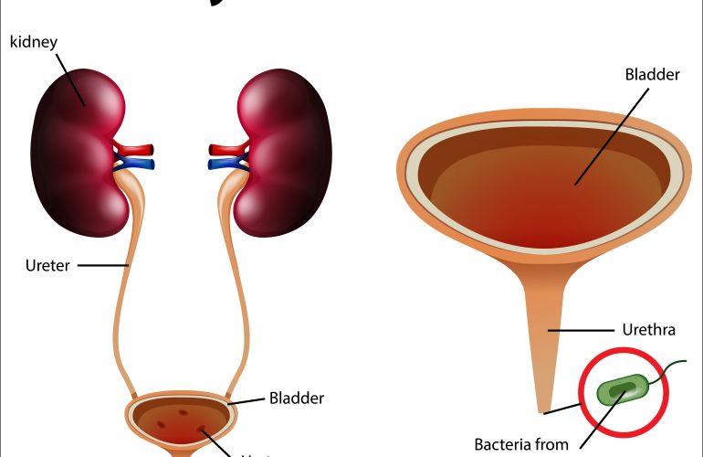 Urinary Tract Infection